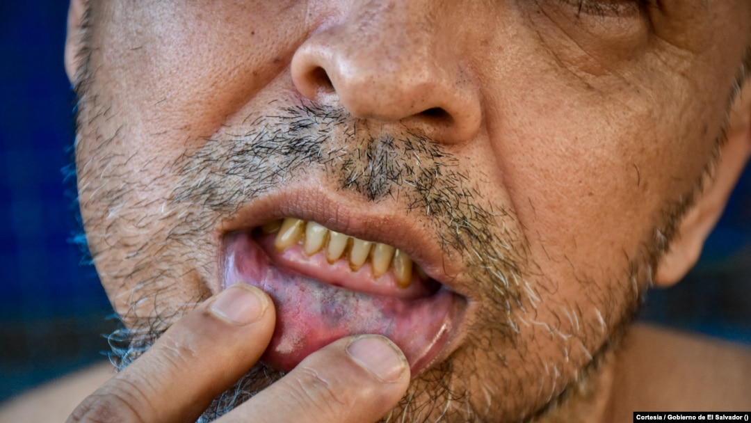 ARCHIVO - Esta fotografía muestra las cicatrices de un tatuaje borrado en una persona identificada por las autoridades salvadoreñas como miembro de una pandilla. [Foto: Cortesía del gobierno de El Salvador]