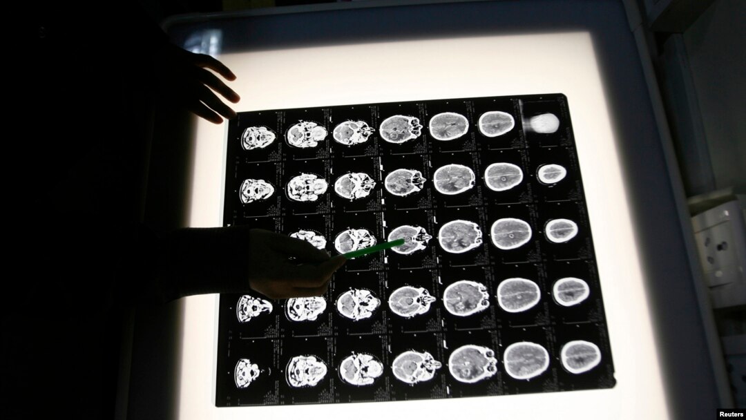 FILE - A radiologist examines the brain X-rays of a patient. In a small study, patients with brain tumors were given genetically modified poliovirus, which helped their bodies attack the cancer.