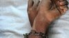 Doctors Battle Psychological Trauma in Dadaab Refugee Camps