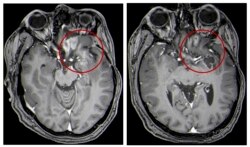 This combination of MRI images provided by the University of Alabama in April 2021 shows scans of a child with a brain tumor, before and after the treatment.