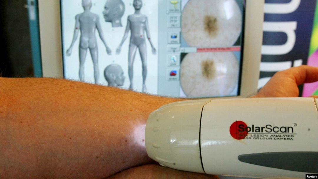 SolaScan, a new device to detect skin cancer, is demonstrated at its launch in Sydney, Australia, May 7, 2002.