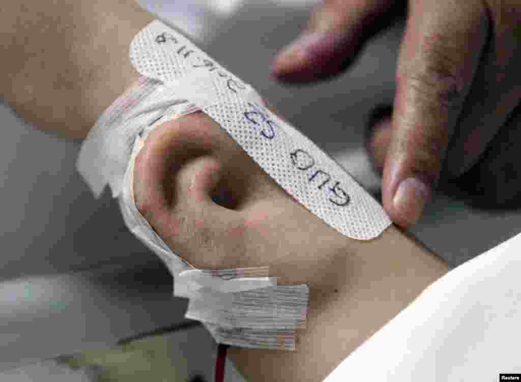 An "ear" is seen growing on the arm of a patient who lost his right ear in an accident, at the first affiliated hospital of Xi'an Jiaotong University, in Xi'an, Shaanxi province, China. The growing "ear," which will be transplanted onto the patient's head in a following surgery, was taken from the patient's rib cartilage, cut into the shape of an ear, and then placed under the skin flap of the arm.