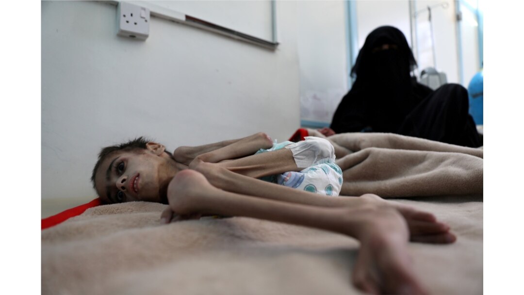 FILE - Faid Samim, 7, a malnourished boy who also has cerebral palsy, lies on a bed at the malnutrition treatment ward of al-Sabeen hospital in Sana'a, Yemen, Dec. 28, 2020.